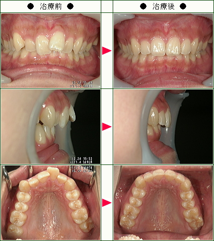 歯のデコボコ矯正症例(美穂様　２０歳　女性)