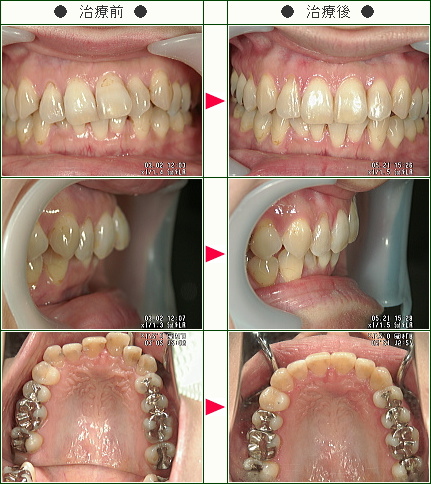 歯のデコボコ矯正症例(ミジンコ様　３５歳　女性)