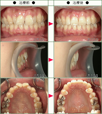 歯のデコボコ矯正症例(みかん様　３１歳　女性)