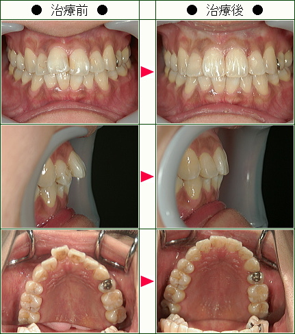 歯のデコボコ矯正症例(三笠様　３４歳　女性)