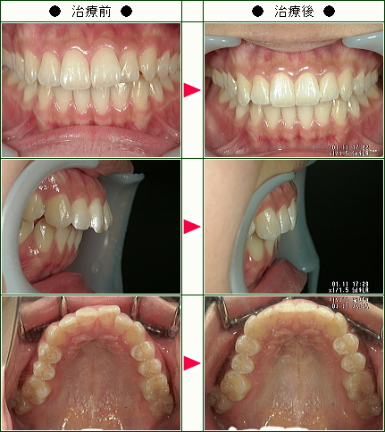 歯のデコボコ矯正症例(みき様　１６歳　女性)