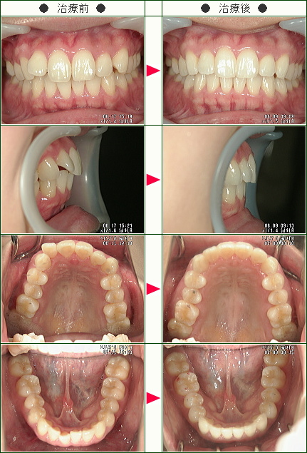 歯のデコボコ矯正症例(みのり様　２７歳　女性)