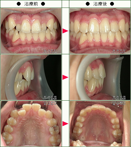 歯のデコボコ矯正症例(光永様　１５歳　男性)