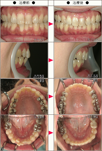 歯のデコボコ矯正症例［ＭＩＷＡ様　３９歳　女性］