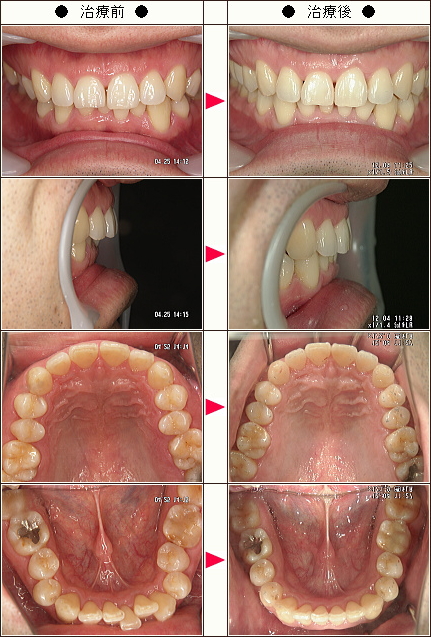 出っ歯矯正症例［宮地様　３０歳　男性］