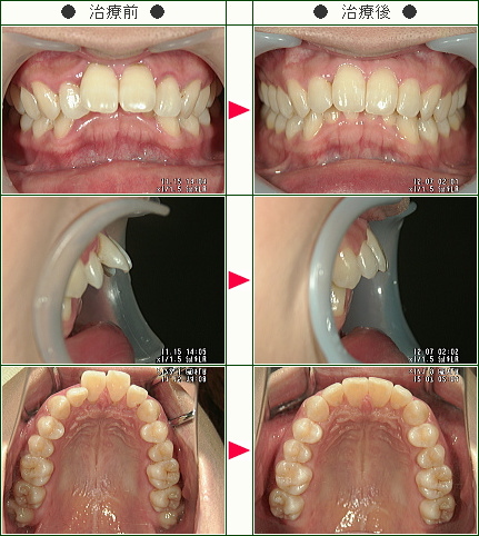 出っ歯矯正症例(三好様　３０歳　女性)
