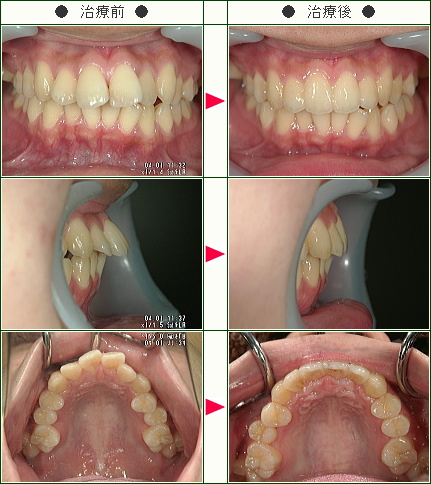 出っ歯矯正症例(Ｍ.Ｋ様　１９歳　女性)