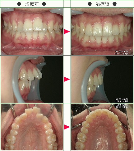 出っ歯矯正症例(Ｍ・Ｋ様　２２歳　女性)