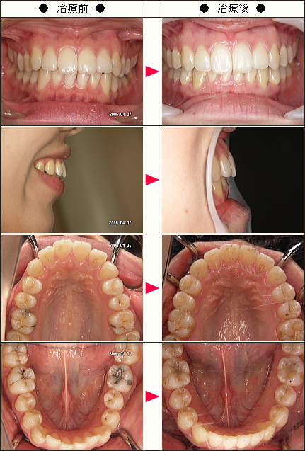 出っ歯矯正症例［Ｍ．Ｋ様　２２歳　女性］