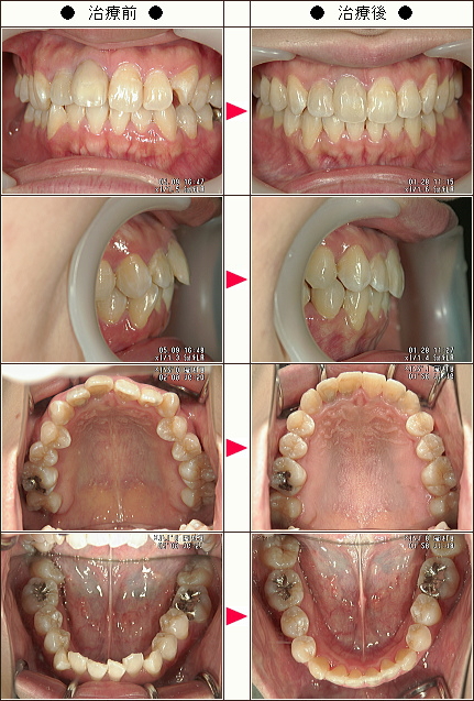 歯のデコボコ矯正症例［Ｍ.Ｋ様　２４歳　女性］