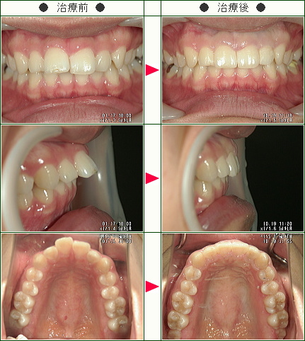 出っ歯矯正症例(ＭＫ様　２４歳　女性)