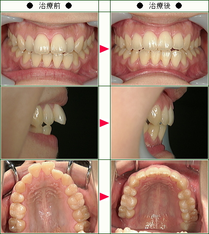 歯のデコボコ矯正症例(Ｍ.Ｋ様　２５歳　女性)