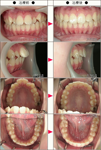 出っ歯矯正症例［ＭＫ様　２５歳　女性］