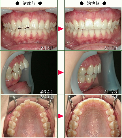 歯のデコボコ矯正症例(Ｍ・Ｋ様　２６歳　女性)
