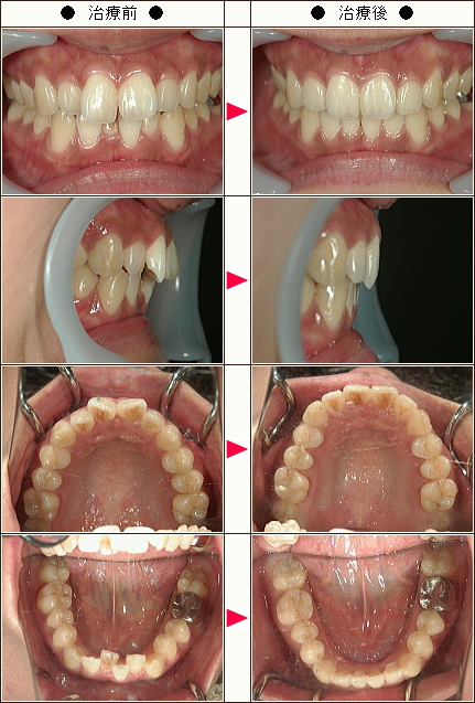 歯のデコボコ矯正症例［Ｍ.Ｋ様　２６歳　女性］