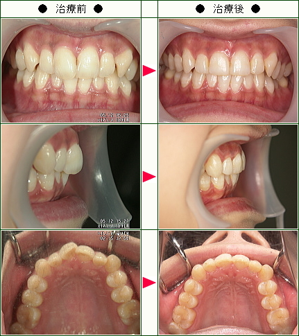 歯のデコボコ矯正症例(Ｍ・Ｋ様　２７歳　女性)