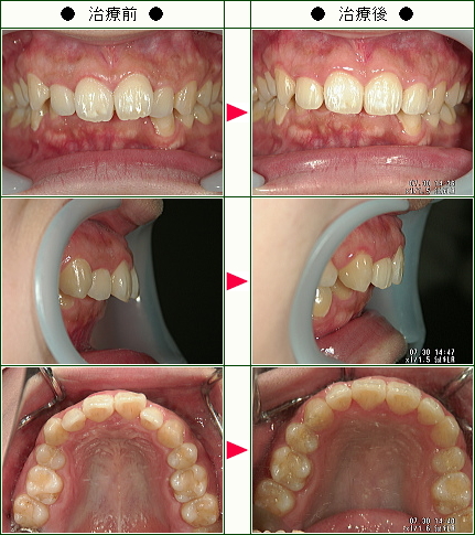 出っ歯矯正症例(Ｍ.Ｋ様　２９歳　女性)