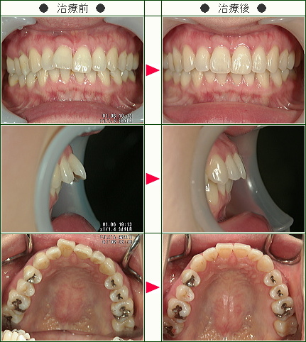出っ歯矯正症例(Ｍ・Ｋ様　３３歳　女性)