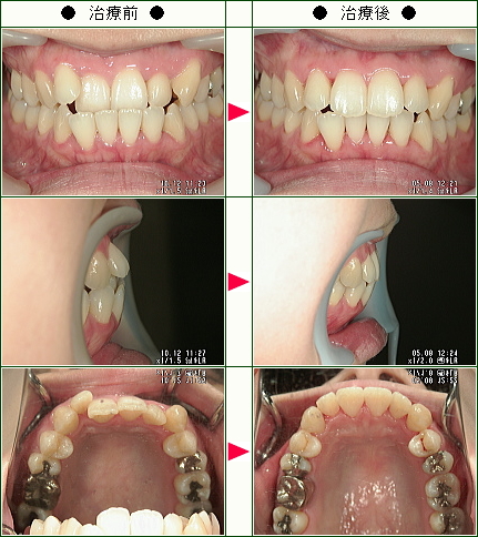 歯のデコボコ矯正症例(ＭＫ様　３５歳　女性)