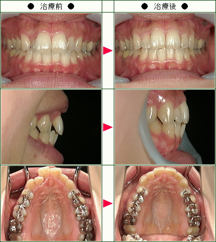歯のデコボコ矯正症例(Ｍ・Ｋ様　３５歳　女性)