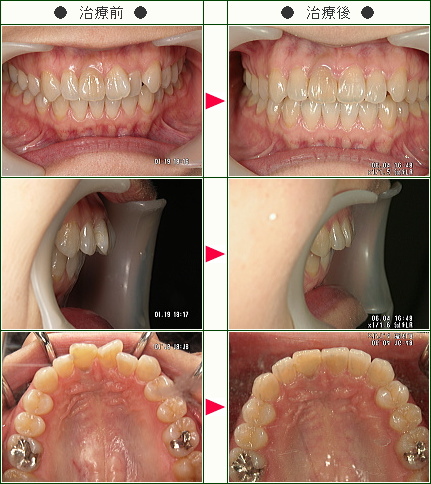歯のデコボコ矯正症例(Ｍ．Ｋ．様　３５歳　女性)