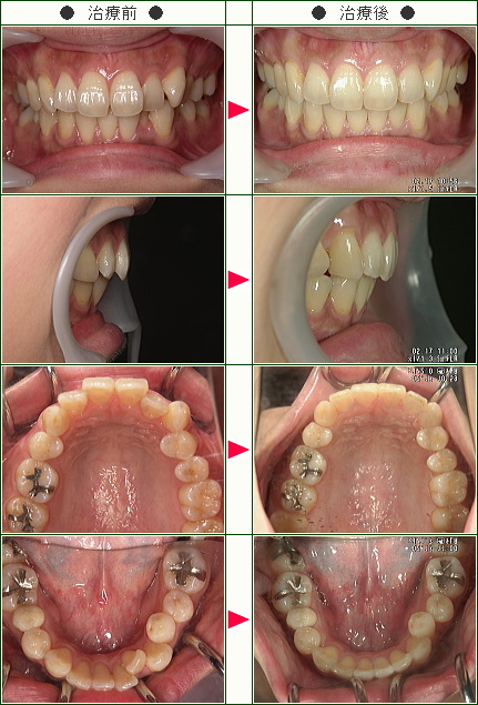 歯のデコボコ矯正症例(Ｍ・Ｋ様　３５歳　女性)