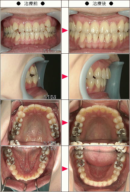 歯のデコボコ矯正症例［Ｍ・Ｋ様　３５歳　女性］