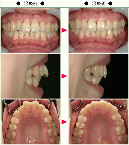 歯のデコボコ矯正症例(Ｍ．Ｋ様　４０歳　女性)