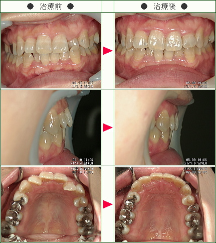 歯のデコボコ矯正症例(Ｍ.Ｋ様　４１歳　女性)