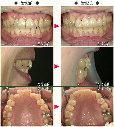 歯のデコボコ矯正症例(Ｍ・Ｋ様　４８歳　女性)