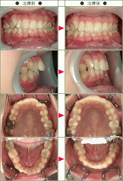 歯のデコボコ矯正症例(Ｍ．Ｍ様　２８歳　女性)