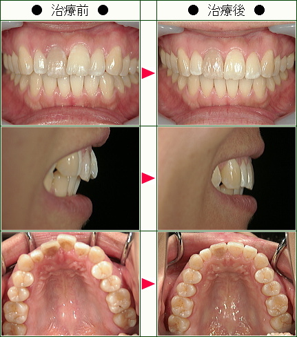 歯のデコボコ矯正症例(Ｍ.Ｍ様　３１歳　女性)
