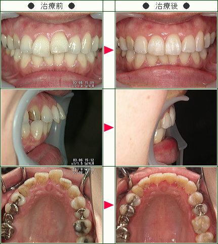 出っ歯矯正症例(Ｍ・Ｍ様　３３歳　女性)