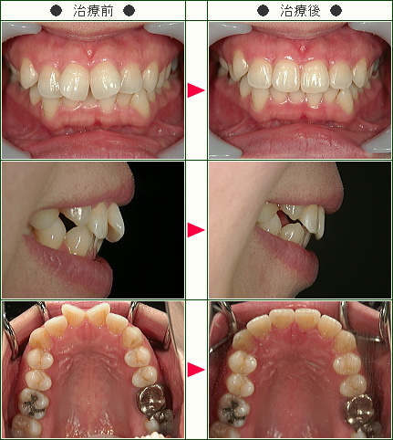 歯のデコボコ矯正症例(Ｍ.Ｍ様　３５歳　女性)