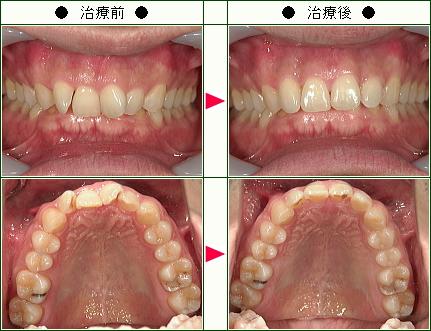 歯のデコボコ矯正症例(Ｍ・Ｍ様　３５歳　男性)