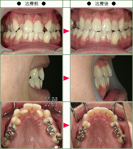 歯のデコボコ矯正症例(Ｍ．Ｍ様　３５歳　男性)
