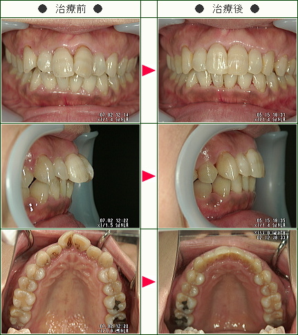 出っ歯矯正症例(Ｍ.Ｍ様　４７歳　女性)