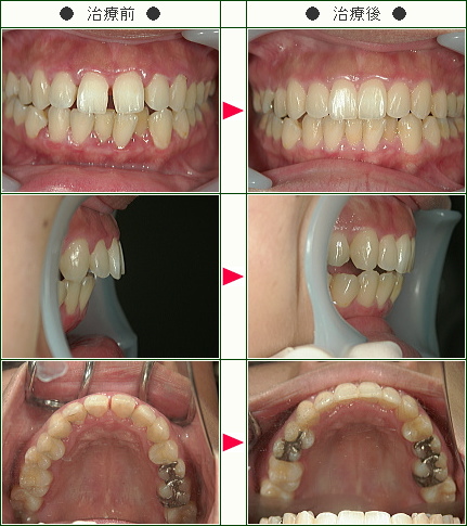 前歯のすきっ歯矯正症例(Ｍ.Ｎ様　２５歳　女性)
