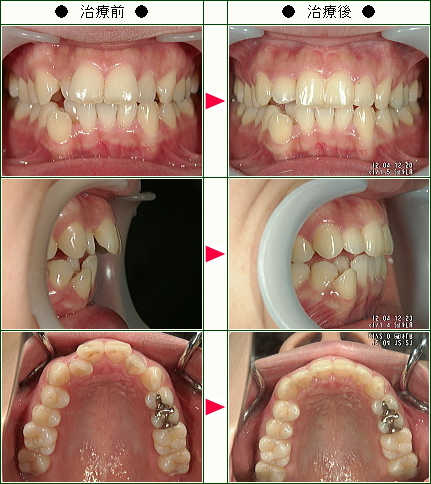 歯のデコボコ矯正症例(Ｍ．Ｎ様　２９歳　女性)