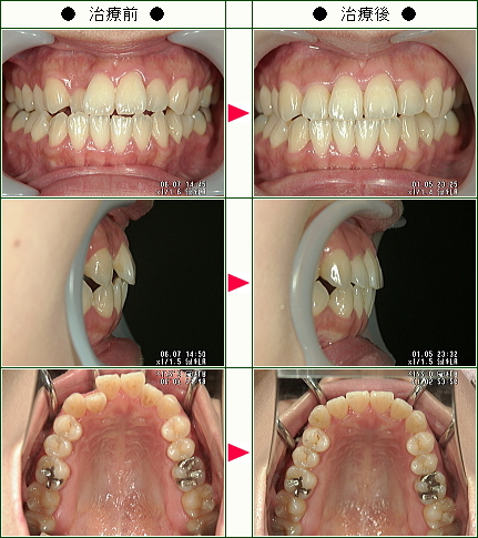歯のデコボコ矯正症例(Ｍ.Ｏ様　３０歳　女性)