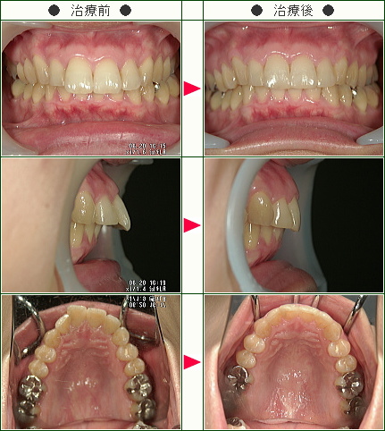 出っ歯矯正症例(Ｍ・Ｏ様　３５歳　女性)
