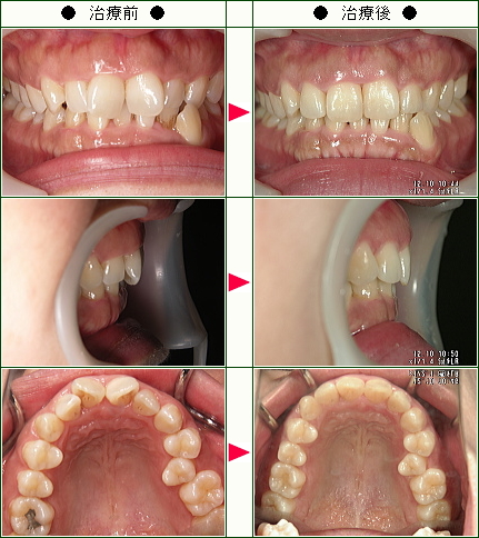 歯のデコボコ矯正症例(Ｍ・Ｏ様　３７歳　女性)