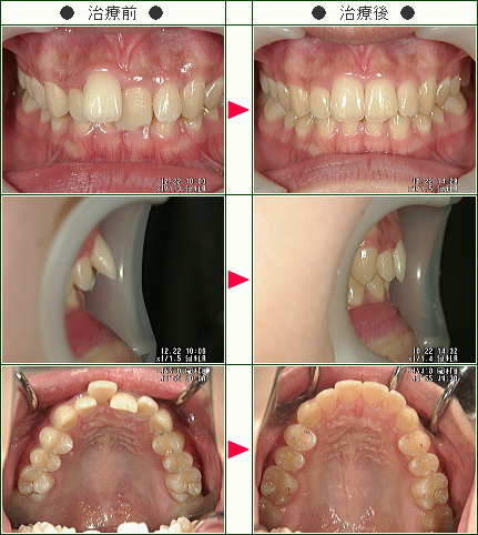 出っ歯矯正症例(ｍｏｅ様　１９歳　女性)