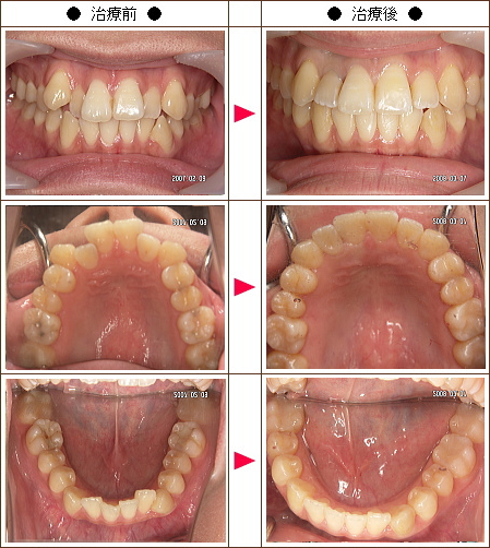 歯のデコボコ矯正症例［もりた様　２８歳　女性］