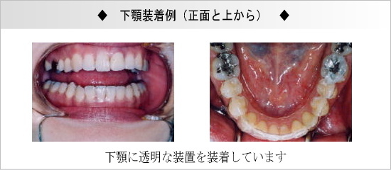 下顎装着例（正面と上から）