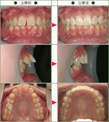 出っ歯矯正症例(Ｍ.Ｓ様　１８歳　女性)