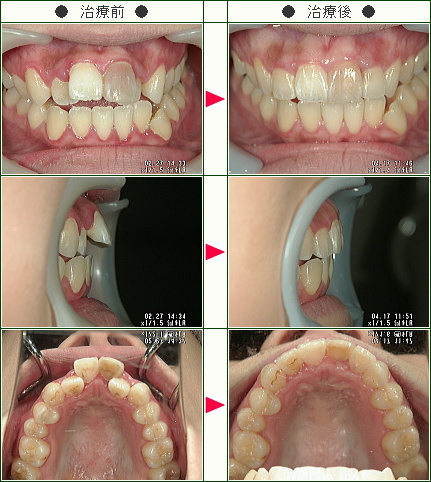 歯のデコボコ矯正症例(Ｍ.Ｓ様　２２歳　女性)