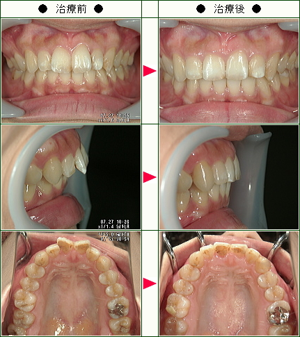 歯のデコボコ矯正症例(Ｍ・Ｓ様　２２歳　女性)