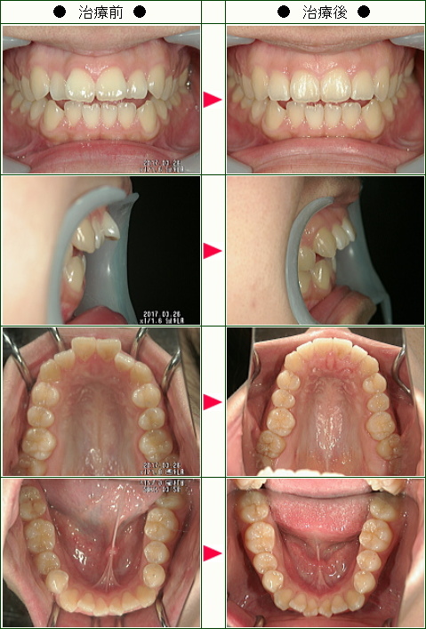 出っ歯矯正症例(Ｍ．Ｓ様　２２歳　女性 )