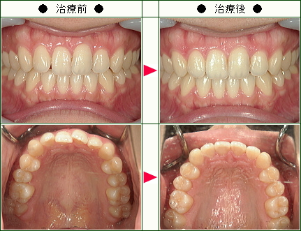 歯のデコボコ矯正症例(Ｍ.Ｓ様　２５歳　女性)